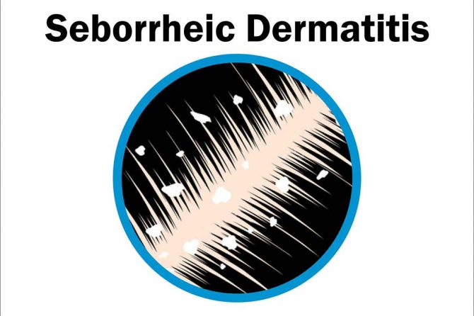 Себореичен дерматит и опаѓање на косата