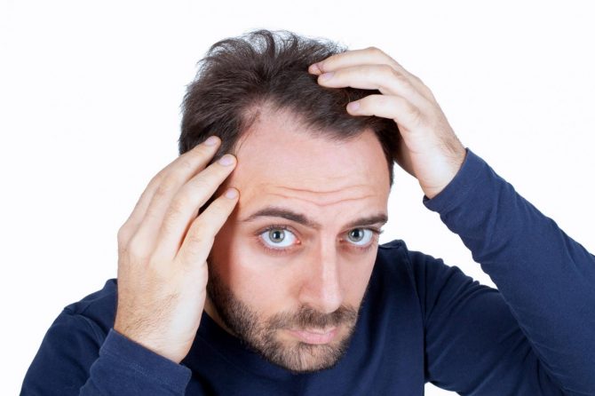 Фронтално опаѓање на косата кај мажи